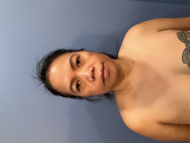 Facial Fat Transfer Before & After Image