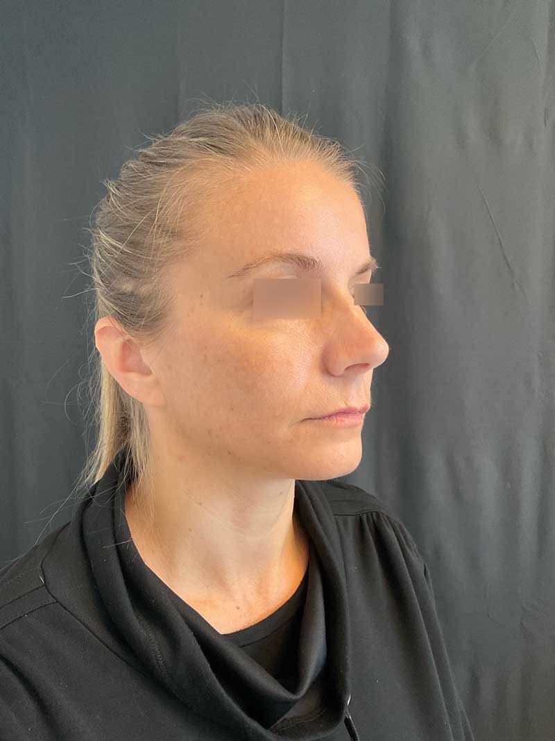 Rhinoplasty Before & After Image