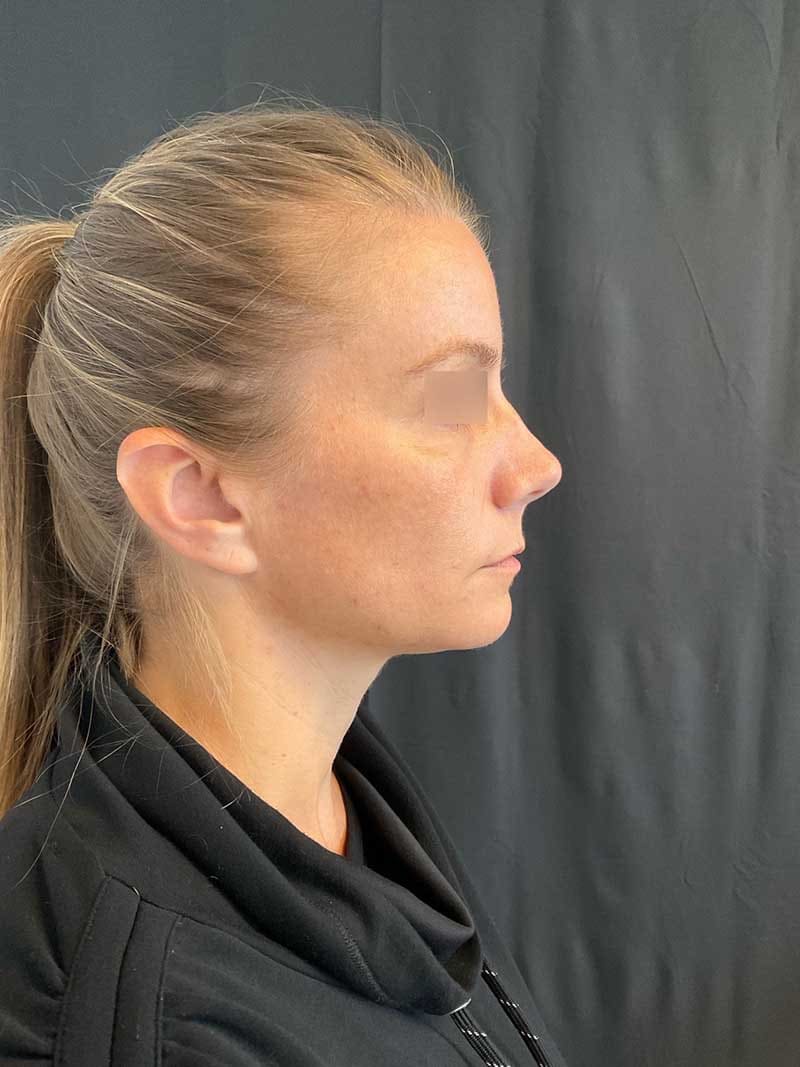 Rhinoplasty Before & After Image