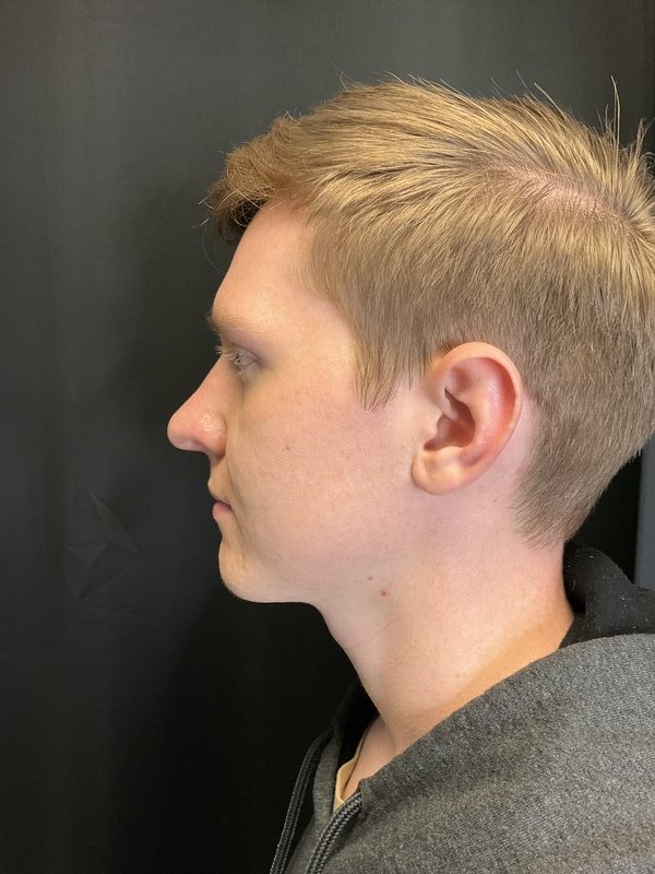 Rhinoplasty Before & After Image