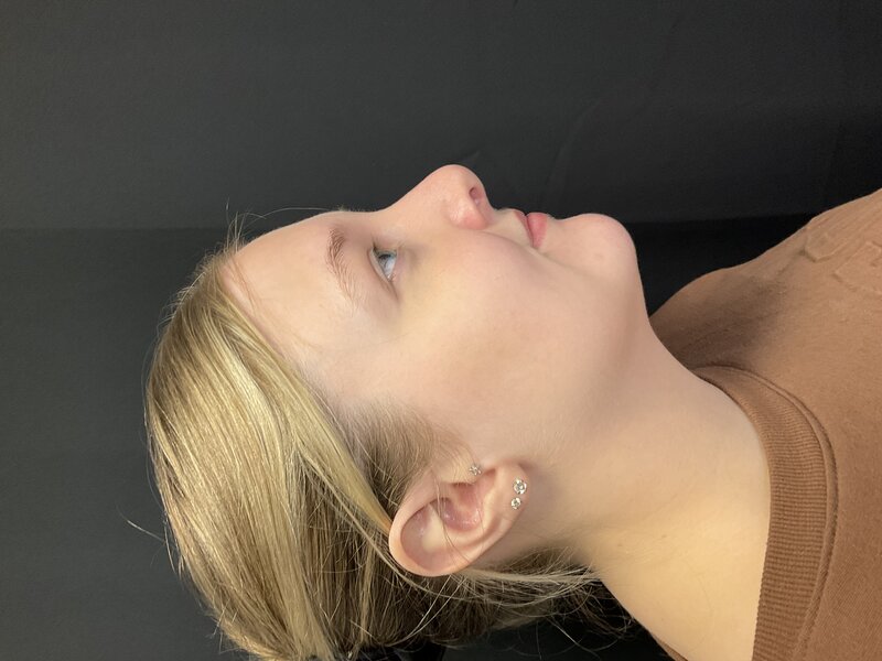 Rhinoplasty Before & After Image