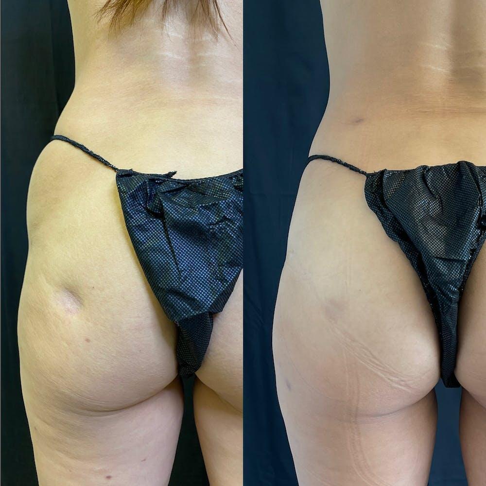 Abdomen Liposuction Before & After Patient 15
