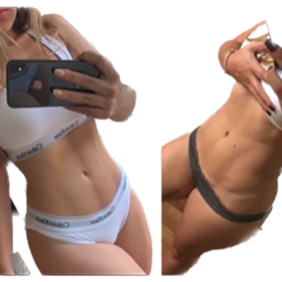 Abdomen Liposuction Before & After Image