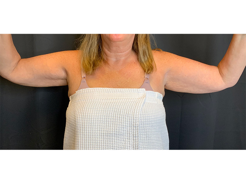 Arm Liposuction Before & After Image