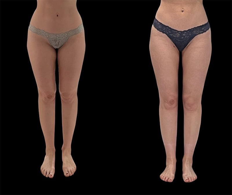 Thigh Liposuction Before & After Image