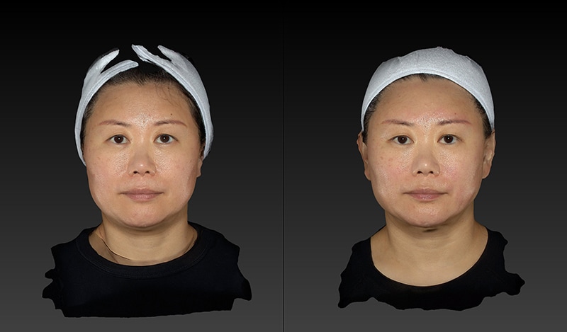 AccuTite Before & After Image