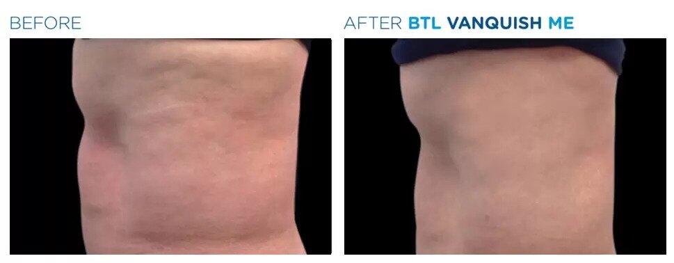 Vanquish Fat Reduction Before & After Image